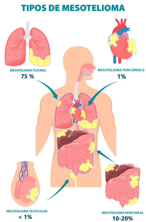 Tipos de Mesotelioma e suas Localizações