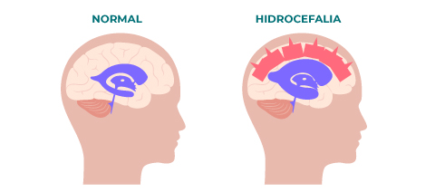 Ilustração comparativa de um cérebro normal e um cérebro com hidrocefalia, mostrando o acúmulo excessivo de líquido.